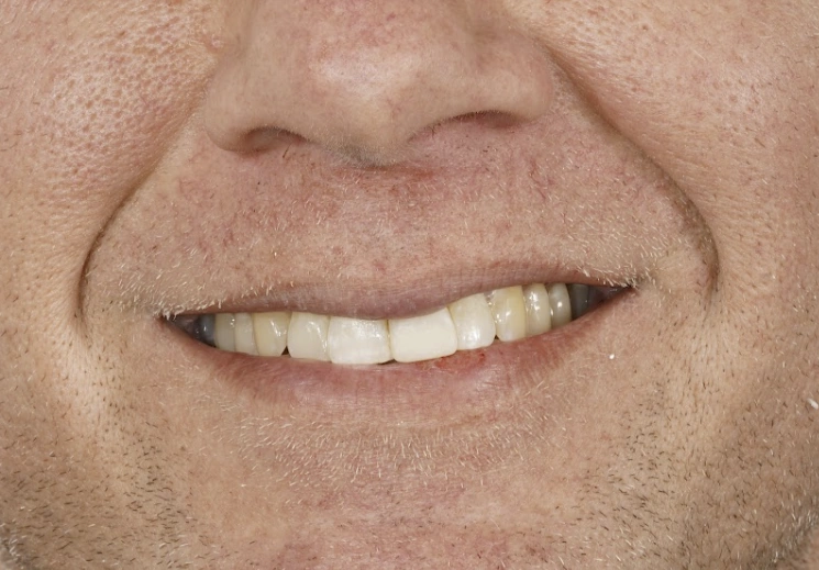 Dental Implant After treatment