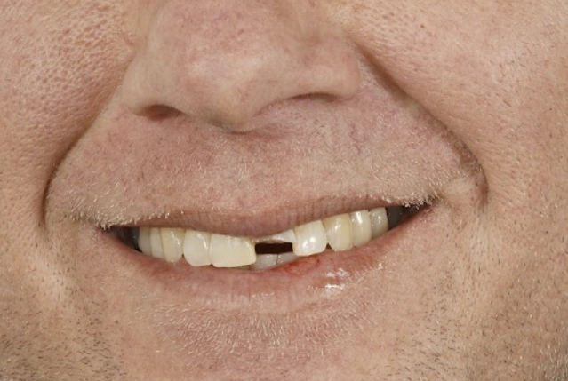 Dental Implant Before treatment